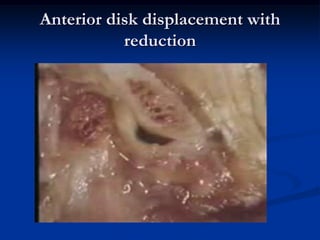 Anterior disk displacement with
reduction

 