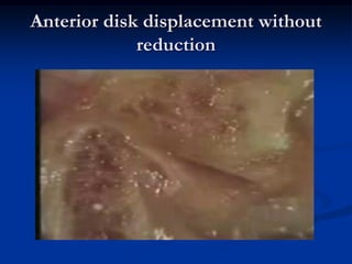 Anterior disk displacement without
reduction

 