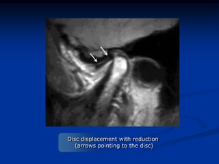 Disc displacement with reduction
(arrows pointing to the disc)

 