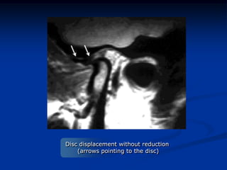 Disc displacement without reduction
(arrows pointing to the disc)

 