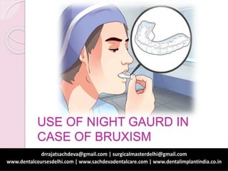 USE OF NIGHT GAURD IN
CASE OF BRUXISM
 