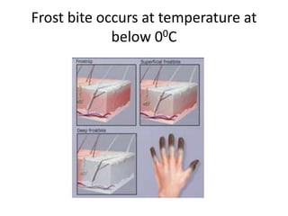 Frost bite occurs at temperature at below 00C