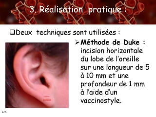 A/S
3. Réalisation pratique :
Deux techniques sont utilisées :
Méthode de Duke :
incision horizontale
du lobe de l’oreille
sur une longueur de 5
à 10 mm et une
profondeur de 1 mm
à l’aide d’un
vaccinostyle.
 