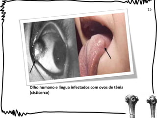 Olho humano e língua infectados com ovos de tênia 
(cisticerco) 
15 
 