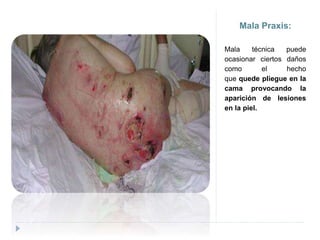 Mala Praxis:
Mala técnica puede
ocasionar ciertos daños
como el hecho
que quede pliegue en la
cama provocando la
aparición de lesiones
en la piel.
 