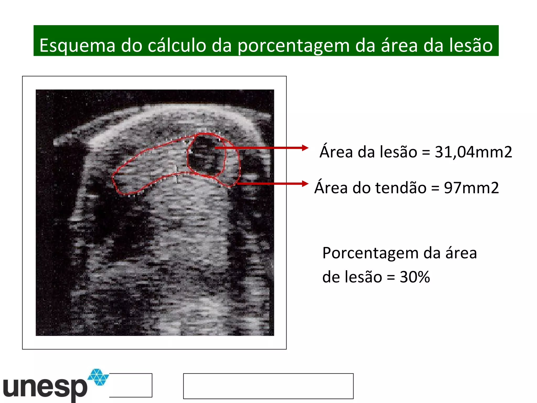 Área da lesão = 31,04mm2 Área do tendão = 97mm2 Porcentagem da área de lesão = 30% Esquema do cálculo da porcentagem da área da lesão 