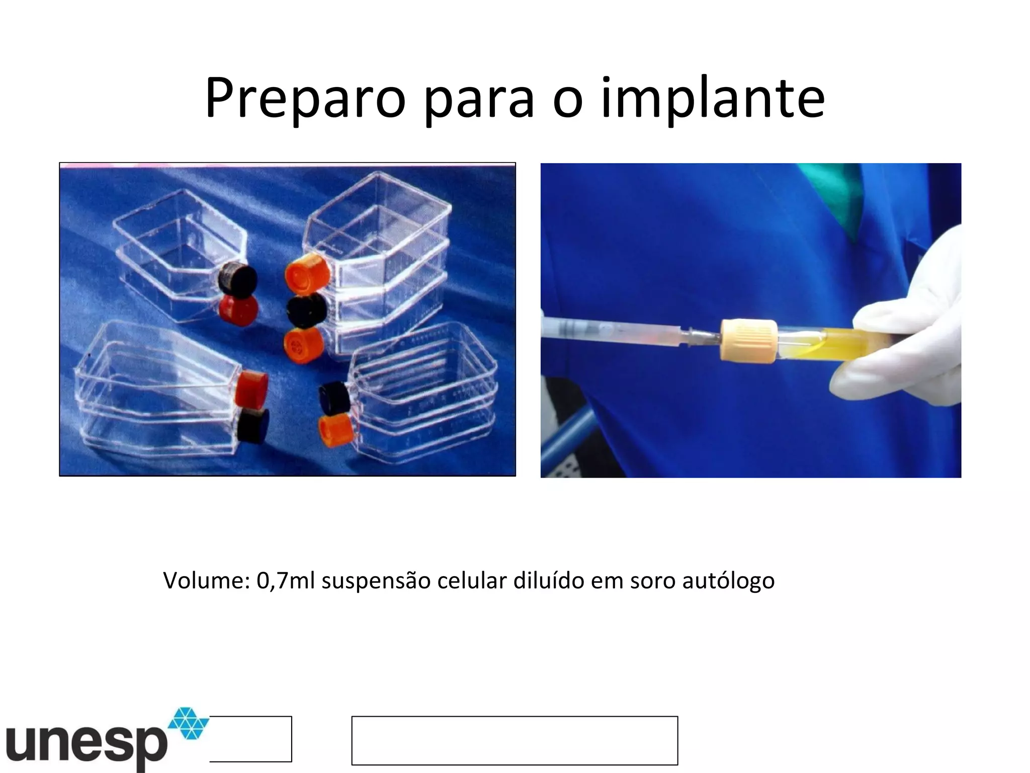Preparo para o implante Volume: 0,7ml suspensão celular diluído em soro autólogo 
