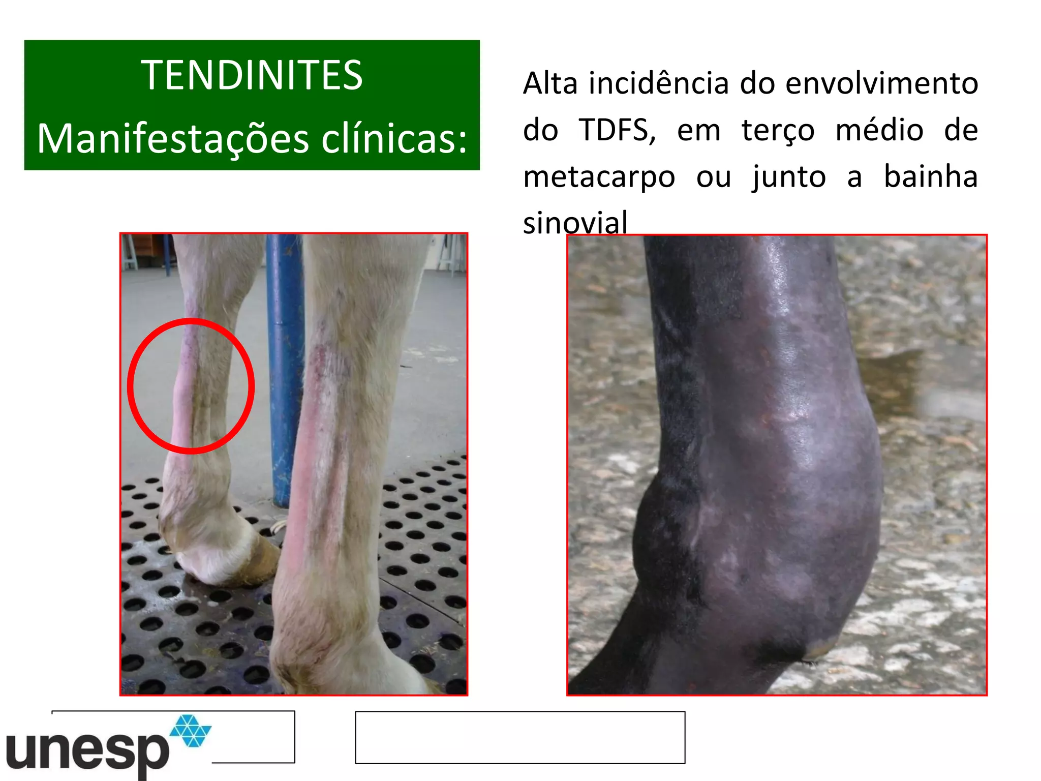 TENDINITES Manifestações clínicas: Alta incidência do envolvimento do TDFS, em terço médio de metacarpo ou junto a bainha sinovial  