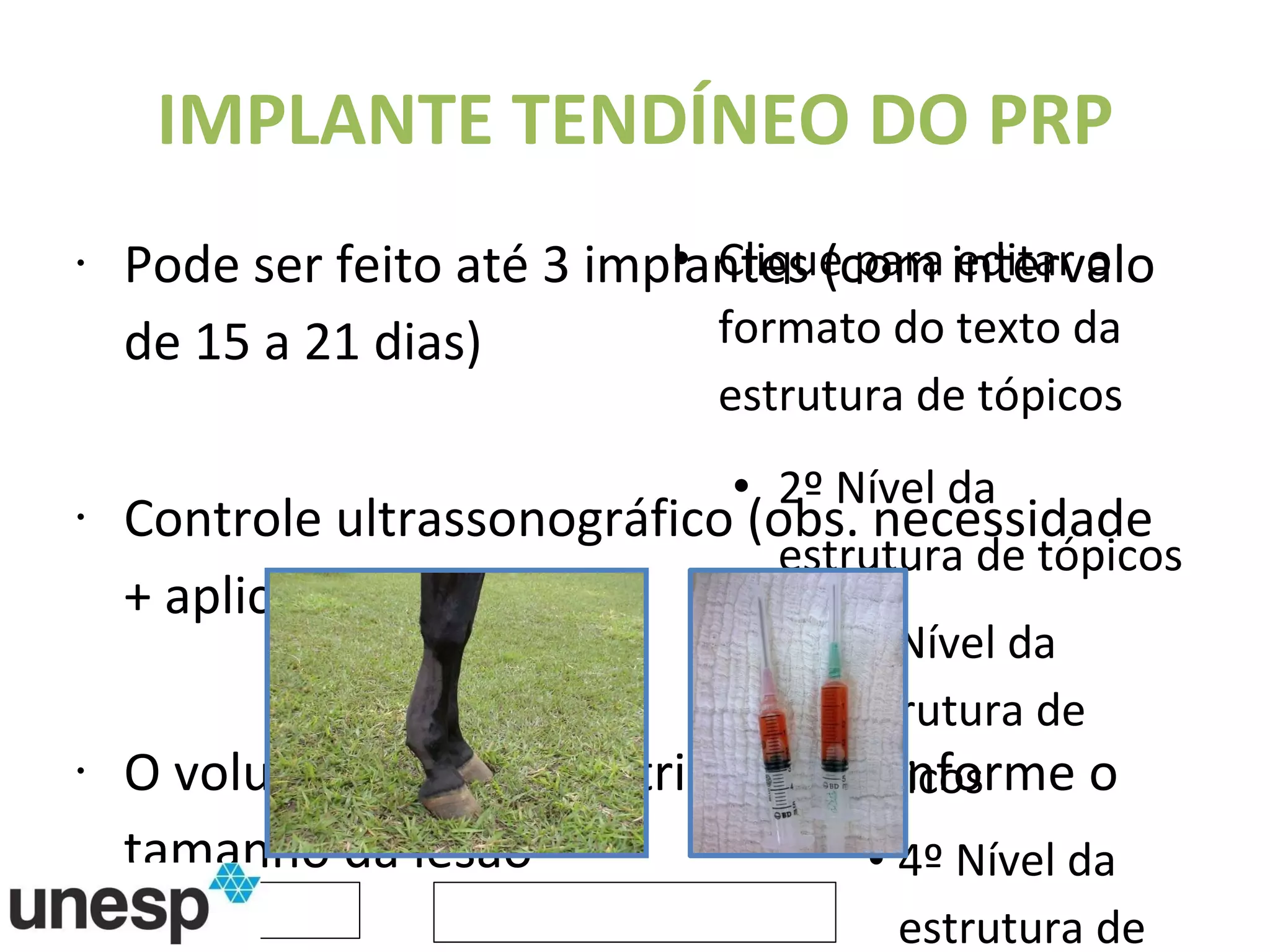 IMPLANTE TENDÍNEO DO PRP Pode ser feito até 3 implantes (com intervalo de 15 a 21 dias) Controle ultrassonográfico (obs. necessidade + aplicações) O volume pode ser distribuídos conforme o tamanho da lesão 