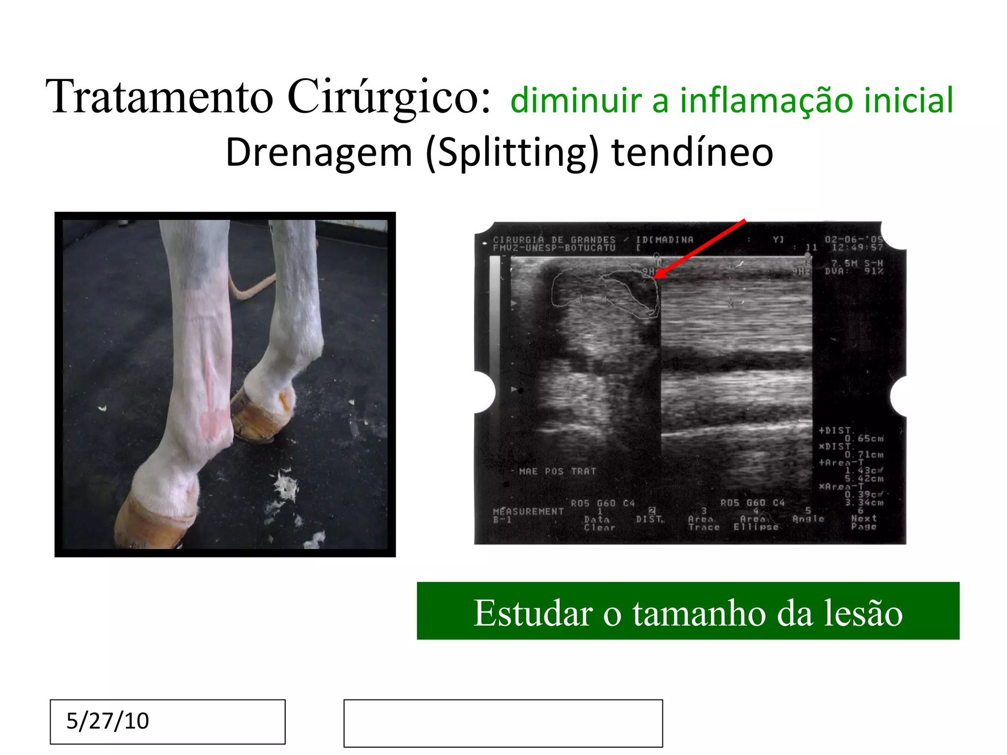 Tratamento Cirúrgico:   diminuir a inflamação inicial   Drenagem (Splitting) tendíneo Estudar o tamanho da lesão 