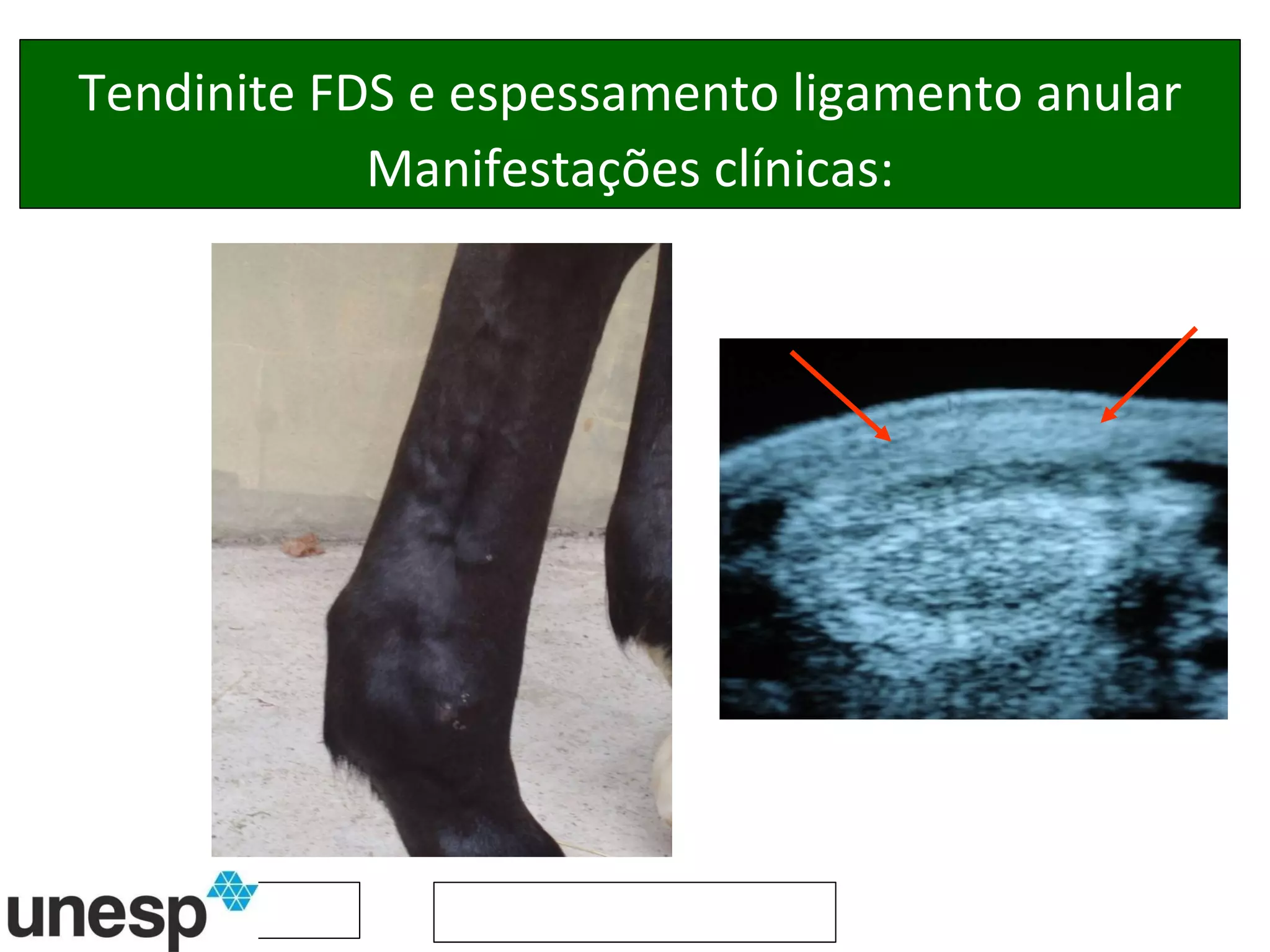 Tendinite FDS e espessamento ligamento anular Manifestações clínicas: 