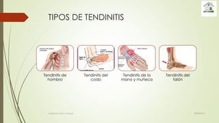 TIPOS DE TENDINITIS
Tendinitis de
hombro
Tendinitis del
codo
Tendinitis de la
mano y muñeca
Tendinitis del
talón
28/04/2015valentina rosero vanegas
 
