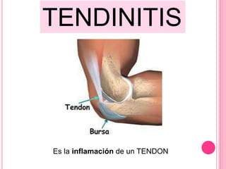TENDINITIS
Es la inflamación de un TENDON
 