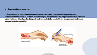 Tendinitis del aductor
La Tenosinovitis de Quervain es una tendinitis que afecta a los tendones que ocupan el primer
compartimento extensor de la mano, abductor largo y extensor corto del pulgar, produciendo dolor con
los movimientos del pulgar. Es el segundo en frecuencia de las tendinitis por atrapamiento en la mano
luego de los dedos en gatillo.
Descargado por Fiorenza Salazar
(fiorenzasalazar1234@gmail.com)
Encuentra más documentos en www.udocz.com
 