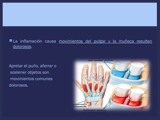 La inflamación causa movimientos del pulgar y la muñeca resulten
dolorosos.
Apretar el puño, aferrar o
sostener objetos son
movimientos comunes
dolorosos.
 