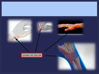ZONAS DE DOLOR
 