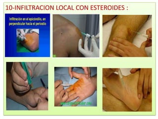 10-INFILTRACION LOCAL CON ESTEROIDES :
 