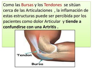 Como las Bursas y los Tendones se sitúan
cerca de las Articulaciones , la inflamación de
estas estructuras puede ser percibida por los
pacientes como dolor Articular y tiende a
confundirse con una Artritis .
 