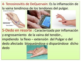 4- Tenosinovitis de DeQuervain: Es la inflamación de
la vaina tendinosa de los tendones del pulgar.




5-Dedo en resorte : Caracterizada por inflamación
y engrosamiento de la vaina del tendón ,
impidiendo la flexo – extensión del Pulgar o del
dedo afectado bloqueándose o disparándose dicho
dedo
 