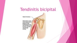 Tendinitis bicipital

 