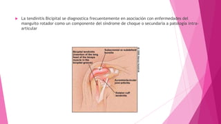 

La tendinitis Bicipital se diagnostica frecuentemente en asociación con enfermedades del
manguito rotador como un componente del síndrome de choque o secundaria a patología intraarticular

 