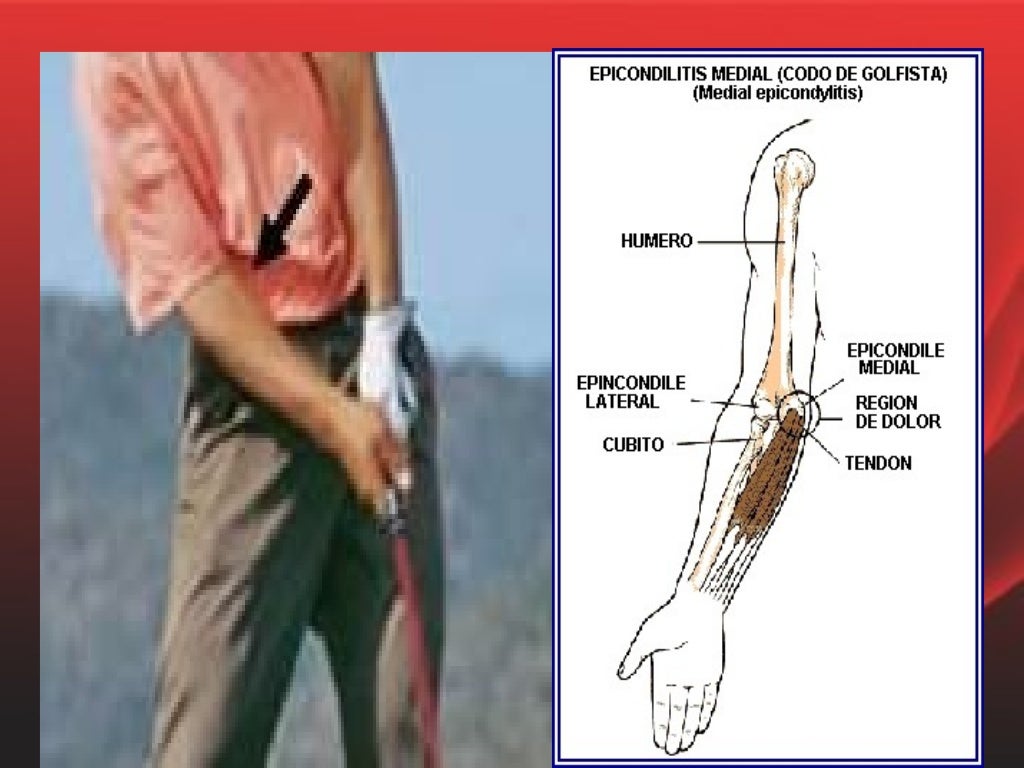 Tendinitis de codo p