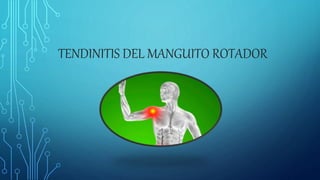 TENDINITIS DEL MANGUITO ROTADOR
 