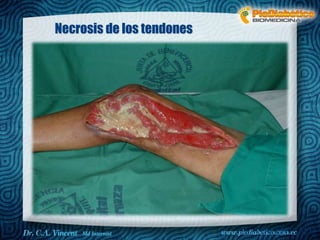 Dr. VINCENT, M.D
Necrosis de los tendones