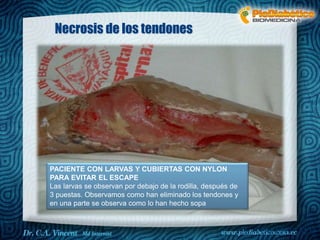 Dr. VINCENT, M.D
Necrosis de los tendones
PACIENTE CON LARVAS Y CUBIERTAS CON NYLON
PARA EVITAR EL ESCAPE
Las larvas se observan por debajo de la rodilla, después de
3 puestas. Observamos como han eliminado los tendones y
en una parte se observa como lo han hecho sopa