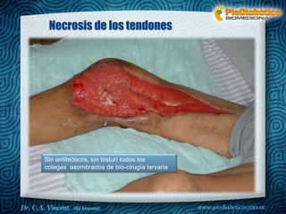 Dr. VINCENT, M.D
Necrosis de los tendones
Sin antibióticos, sin bisturí todos los
colegas asombrados de bio-cirugía larvaria