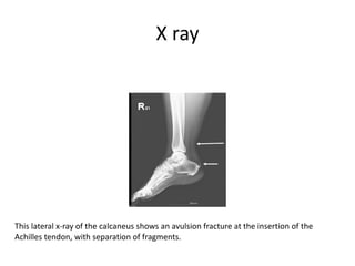 X ray
This lateral x-ray of the calcaneus shows an avulsion fracture at the insertion of the
Achilles tendon, with separation of fragments.
 