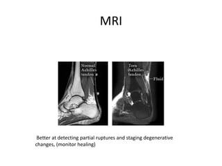 MRI
Better at detecting partial ruptures and staging degenerative
changes, (monitor healing)
 