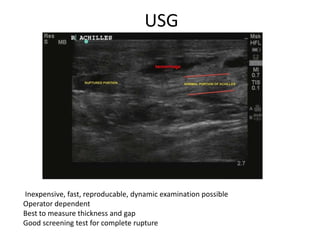 USG
Inexpensive, fast, reproducable, dynamic examination possible
Operator dependent
Best to measure thickness and gap
Good screening test for complete rupture
 