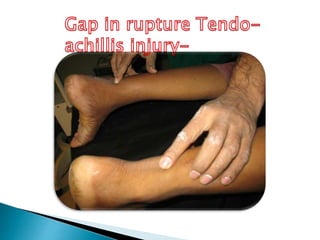 Tendo achilles inflammation and rupture