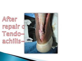 Tendo achilles inflammation and rupture