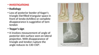 Ta Rupture Tendo achilles rupture presentation.pptx