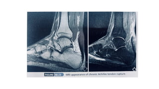 Ta Rupture Tendo achilles rupture presentation.pptx