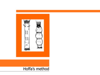 Hoffa’s method
 