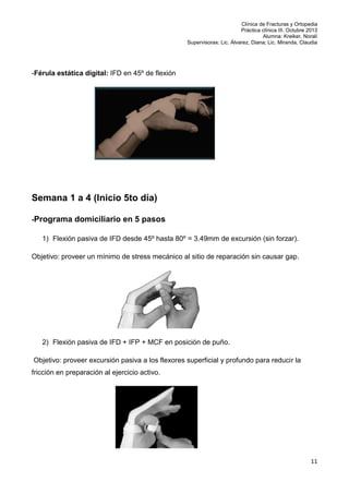 Clínica de Fracturas y Ortopedia
Práctica clínica III. Octubre 2013
Alumna: Kreiker, Noralí
Supervisoras: Lic. Álvarez, Diana; Lic. Miranda, Claudia

-Férula estática digital: IFD en 45º de flexión

Semana 1 a 4 (Inicio 5to día)
-Programa domiciliario en 5 pasos
1) Flexión pasiva de IFD desde 45º hasta 80º = 3.49mm de excursión (sin forzar).
Objetivo: proveer un mínimo de stress mecánico al sitio de reparación sin causar gap.

2) Flexión pasiva de IFD + IFP + MCF en posición de puño.
Objetivo: proveer excursión pasiva a los flexores superficial y profundo para reducir la
fricción en preparación al ejercicio activo.

11

 