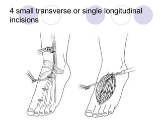 flexor TENDON GRAFTING one and two stage.ppt
