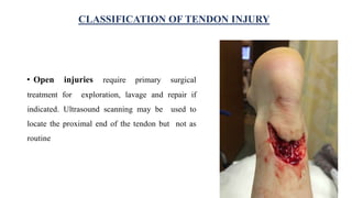 • Open injuries require primary surgical
treatment for exploration, lavage and repair if
indicated. Ultrasound scanning may be used to
locate the proximal end of the tendon but not as
routine
CLASSIFICATION OF TENDON INJURY
 