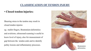 • Closed tendon injuries:
Shearing stress to the tendon may result in
closed tendon injuries
eg.: mallet fingers, Boutonniere deformities
and avulsions, ultrasound scanning is useful to
know level of injury, also for measurement of
gap between the tendon ends and to identify
pulley lesions and inflammatory processes.
CLASSIFICATION OF TENDON INJURY
mallet fingers
Boutonniere
deformities
 