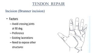 Incision (Brunner incision)
TENDON REPAIR
 