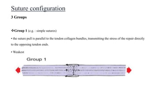 Suture configuration
3 Groups
Group 1 (e.g. : simple sutures)
• the suture pull is parallel to the tendon collagen bundles, transmitting the stress of the repair directly
to the opposing tendon ends.
• Weakest
 