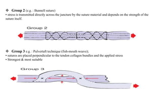  Group 2 (e.g. : Bunnell suture)
• stress is transmitted directly across the juncture by the suture material and depends on the strength of the
suture itself.
 Group 3 e.g. : Pulvertaft technique (fish-mouth weave);
• sutures are placed perpendicular to the tendon collagen bundles and the applied stress
• Strongest & most suitable
 