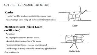 SUTURE TECHNIQUE (End-to-End)
Kessler
• Mainly used for tendon repair in the fingers and palm.
• disadvantage: knots being left exposed on the tendon surface
Modified Kessler (Smith-Evans
modification)
Advantage:
• A single piece of suture material is used.
• knot is left in the cut surface of the tendon.
• minimize the problem of exposed suture material
Disadvantage: difficulty to achieve satisfactory approximation
of the tendon ends.
 