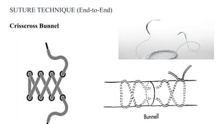 SUTURE TECHNIQUE (End-to-End)
Crisscross Bunnel
 
