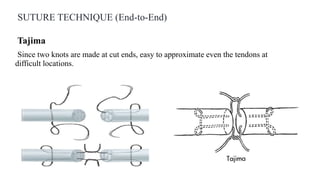 SUTURE TECHNIQUE (End-to-End)
Tajima
Since two knots are made at cut ends, easy to approximate even the tendons at
difficult locations.
 