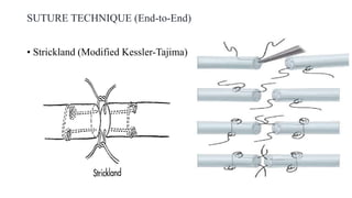 SUTURE TECHNIQUE (End-to-End)
• Strickland (Modified Kessler-Tajima)
 