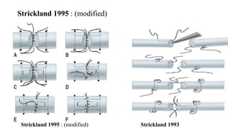 Strickland 1995 : (modified)
Strickland 1995 : (modified) Strickland 1993
 
